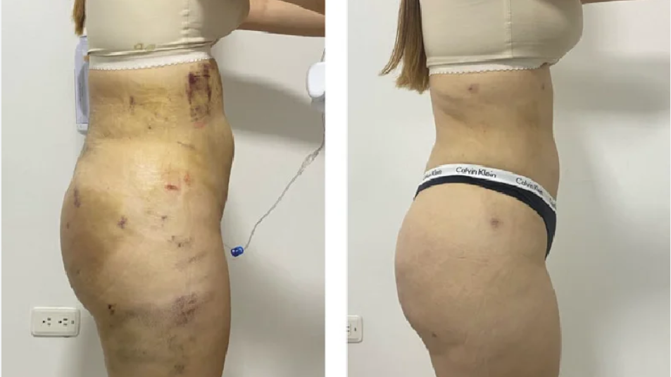 Tratamento eficaz para lipedema