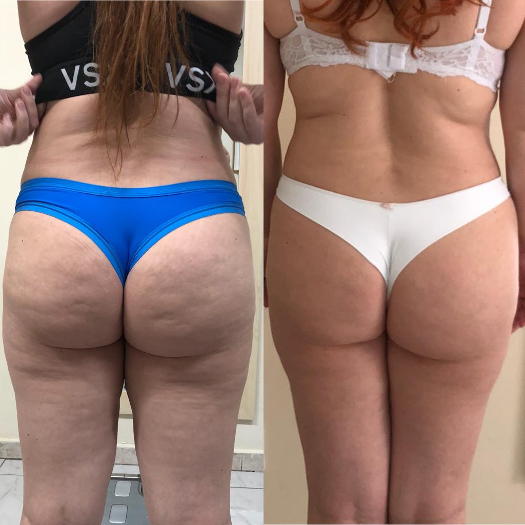 Melhora da celulite e firmeza da pele