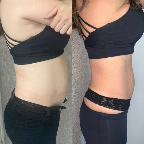 Redução de gordura localizada