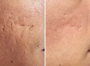 Cicatrizes e Textura