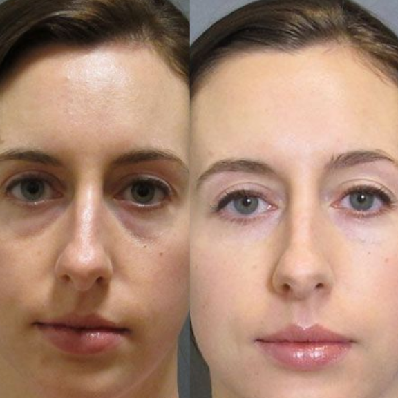 Lifting Facial